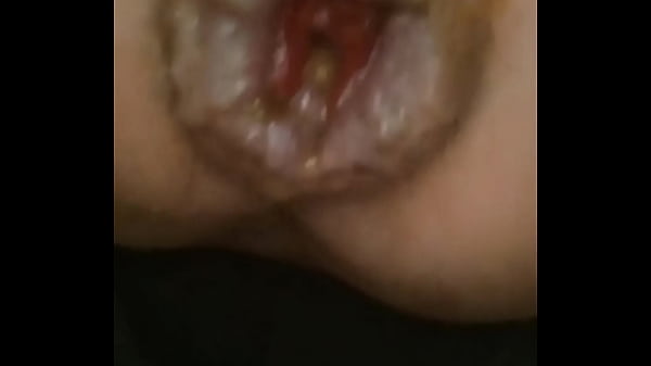 I jerk off my hemorrhoidal rose until it prolapses